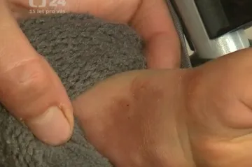 Zrádné úrazy. Popáleninám dětí lze většinou zabránit prevencí, říkají odborníci