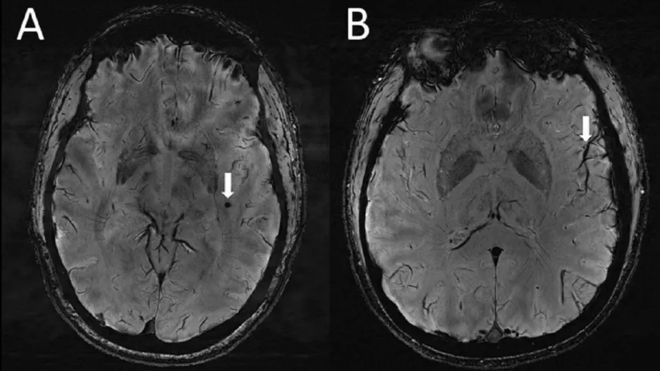 Mozek s migrénou, šipkou vyznačena centra bolesti