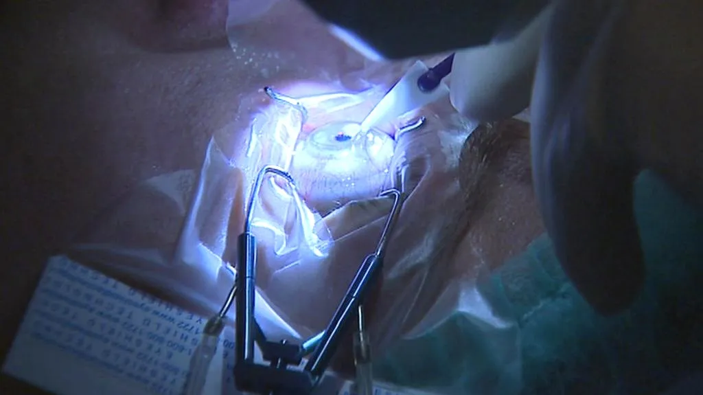 Laserová operace oka