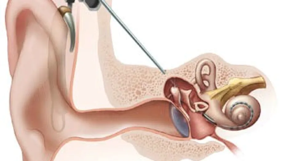 Kresba umístění kochleárního implantátu
