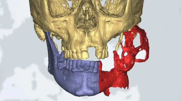 Rekonstrukce čelisti napadené rakovinou pomocí 3D technologie – nádor je označený červeně