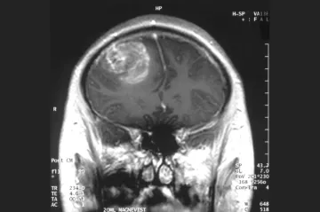 Zjišťujeme, co „zázrak“ způsobilo, říká doktor léčící děti s rakovinou mozku