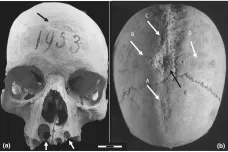 Středověká žena prodělala několik trepanací lebky. Vědci řeší, kdo a proč mohl zákrok provést