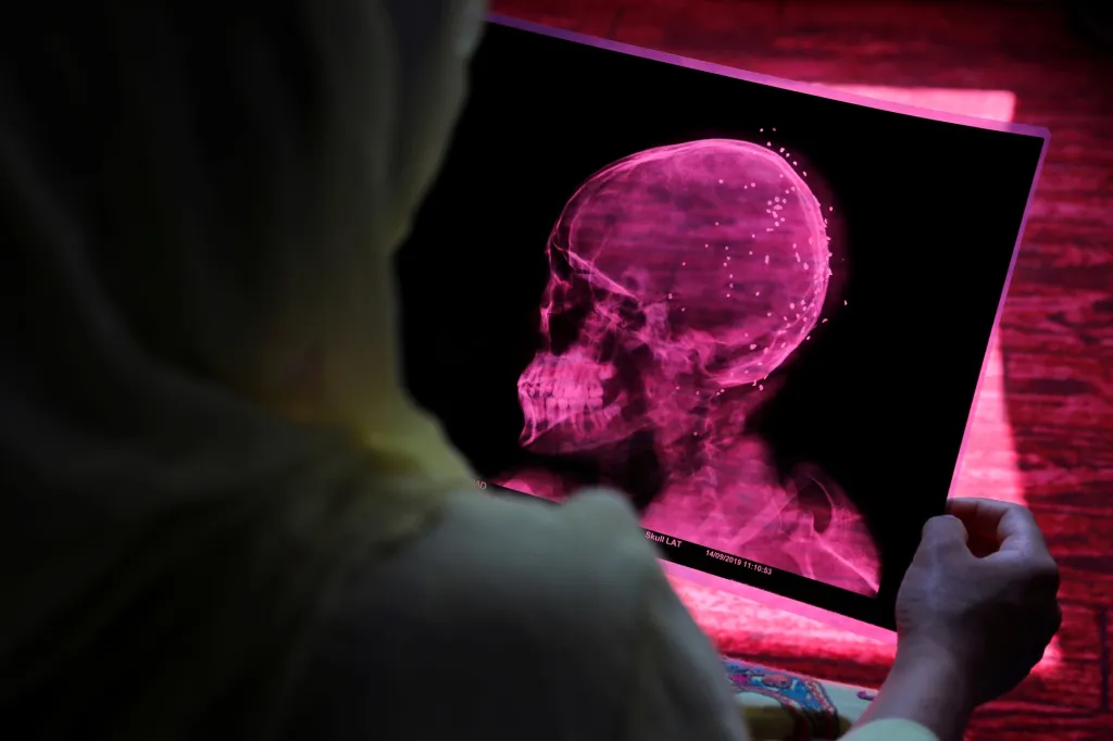 Kašmírem otřásají nepokoje proti indické vládě již několik týdnů. Indická policie někdy používá zbraně, které způsobují rozsáhlá zranění. Na snímku je rentgenový snímek patnáctileté dívky, kterou zasáhly střepiny z granátu