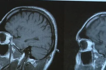 Australští vědci vytvořili hydrogel pro boj s Parkinsonovou chorobou. Je jako náplast na mozek