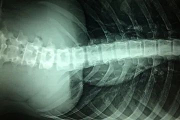 Lékaři z Yaleovy univerzity opravili narušenou míchu pomocí kmenových buněk