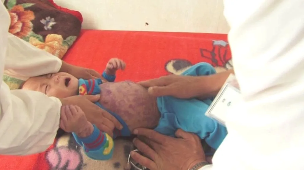 Podvyživené korejské dítě