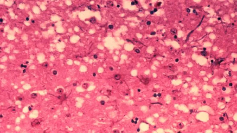 Mozková tkáň krávy postižené BSE