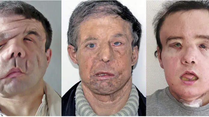 Hamon před a po dvou transplantacích oblčeje