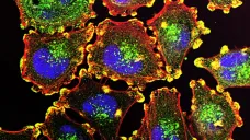 Buňky rakovinového bujení – melanomu
