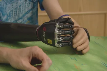 O sbírky na moderní protézy pro děti bez rukou mají dárci zájem. O náhradu usiluje i čtyřletý chlapec