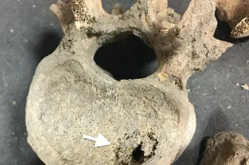 Rakovina není nemoc moderní doby. Ve středověké Británii trápila desetinu dospělých, ukázal výzkum