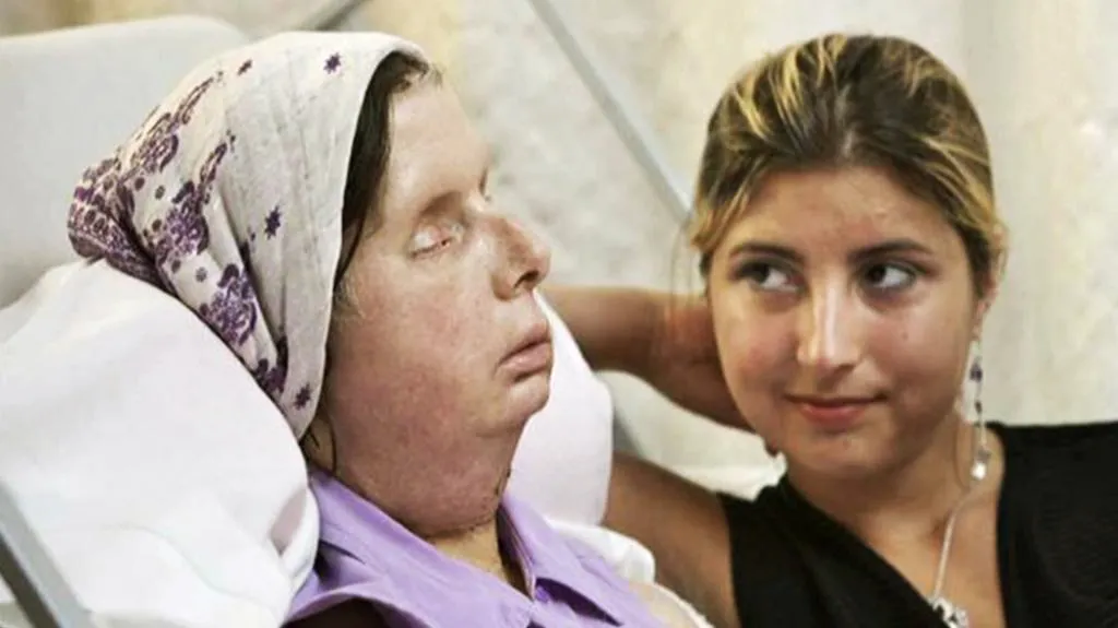 Charla Nashová po transplantaci obličeje