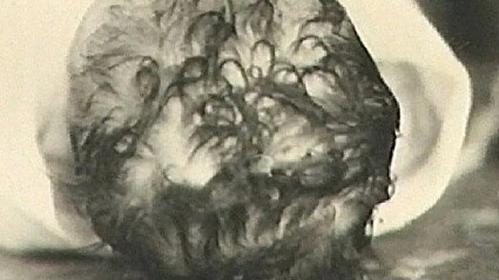 Hlavička postiženeho dítěte