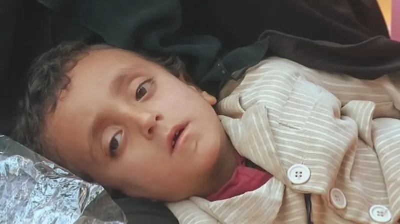 Dítě trpící cholerou