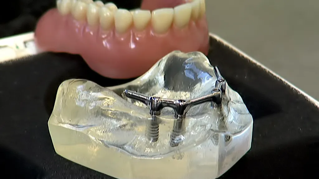 Zubní náhrady
