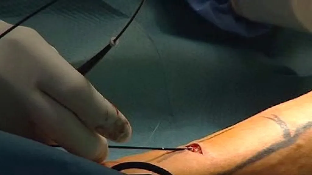 Miniinvazivní odstranění křečových žil