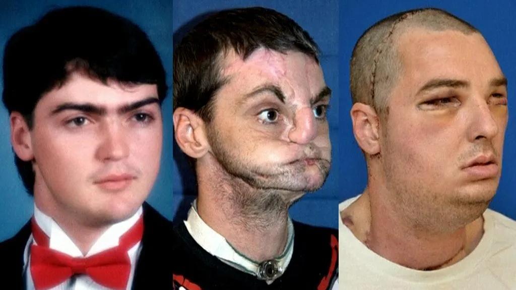 Richard před nehodou, po nehodě a po transplantaci obličeje