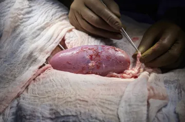 Vědci transplantovali prasečí ledvinu mrtvému člověku. Experiment prokázal, že to může fungovat