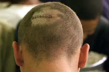 Vědci obelstili buňky, aby účinněji hojily jizvy