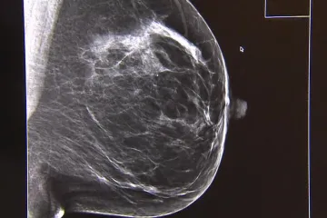 Genetické testy odhalí náchylnost k rakovině prsu