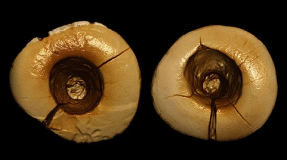 Zubařský zákrok starý tisíce let