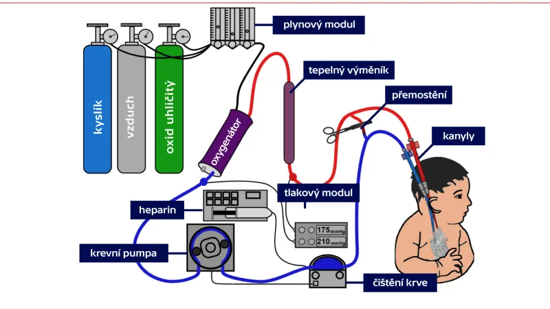 ECMO