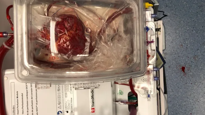 Napojení srdce na teplý roztok krve s O2, zajištění průtoku na bijícím srdci