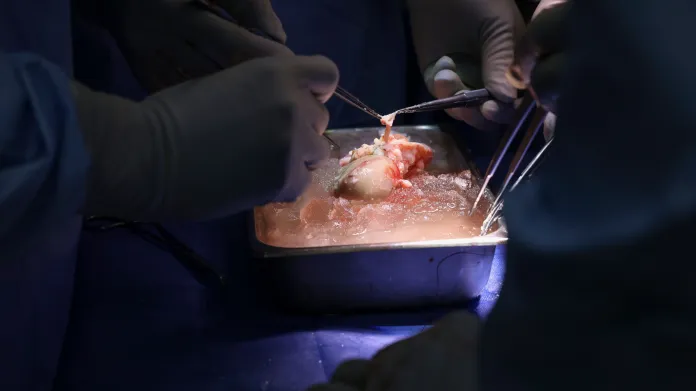 Transplantace prasečí ledviny člověku