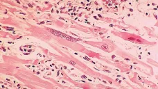 Toxoplasma gondii