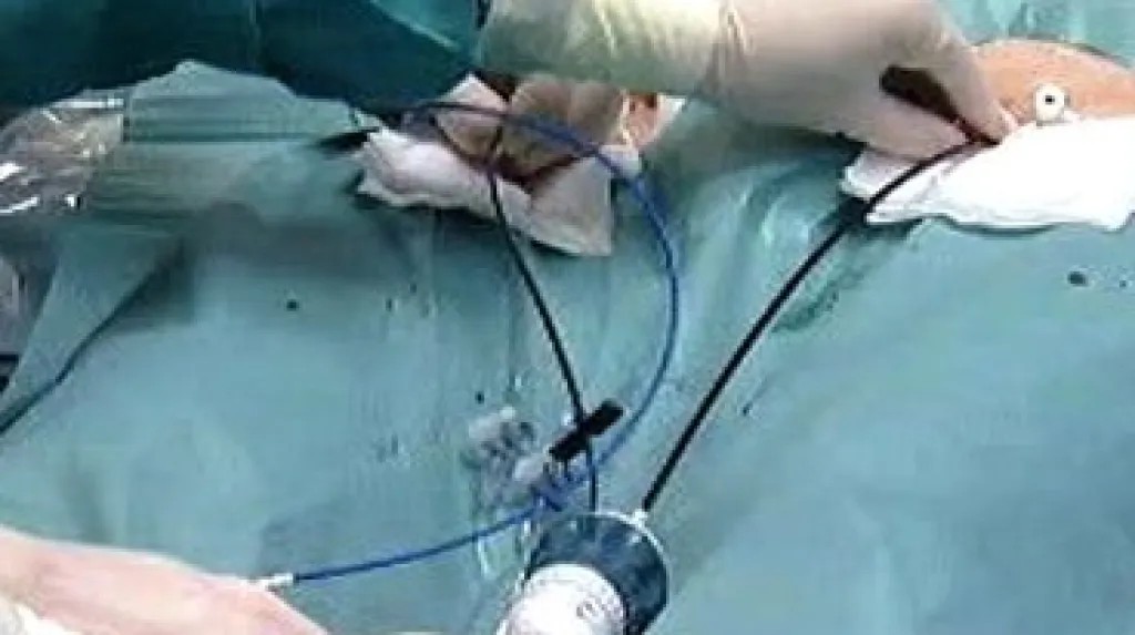 Operace srdce, zavedení katetru stehenní tepnou