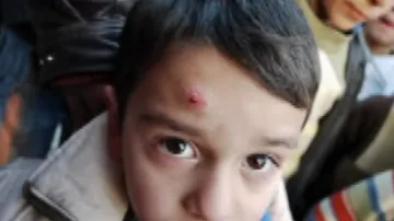 Obyvatelé Aleppa trápí leishmanióza