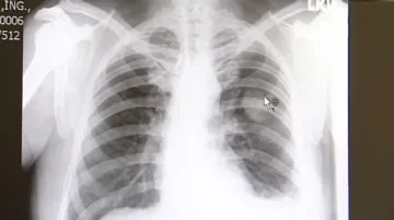 Metastázy v oblasti plic