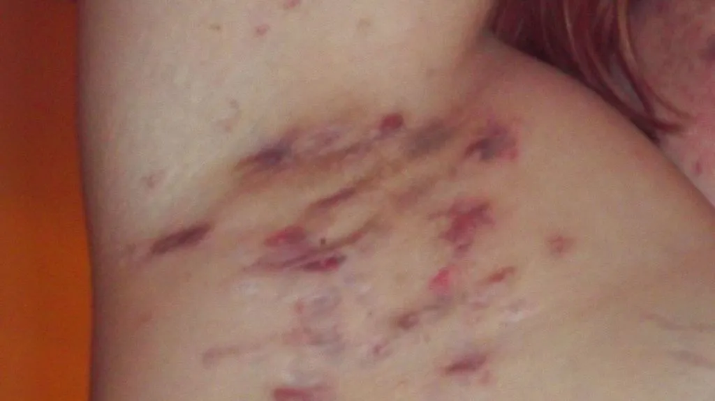 Hidradenitis suppurativa se projevuje zánětlivými ložisky