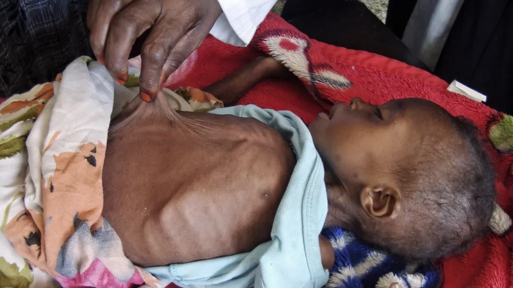 Hladomor v Somálsku