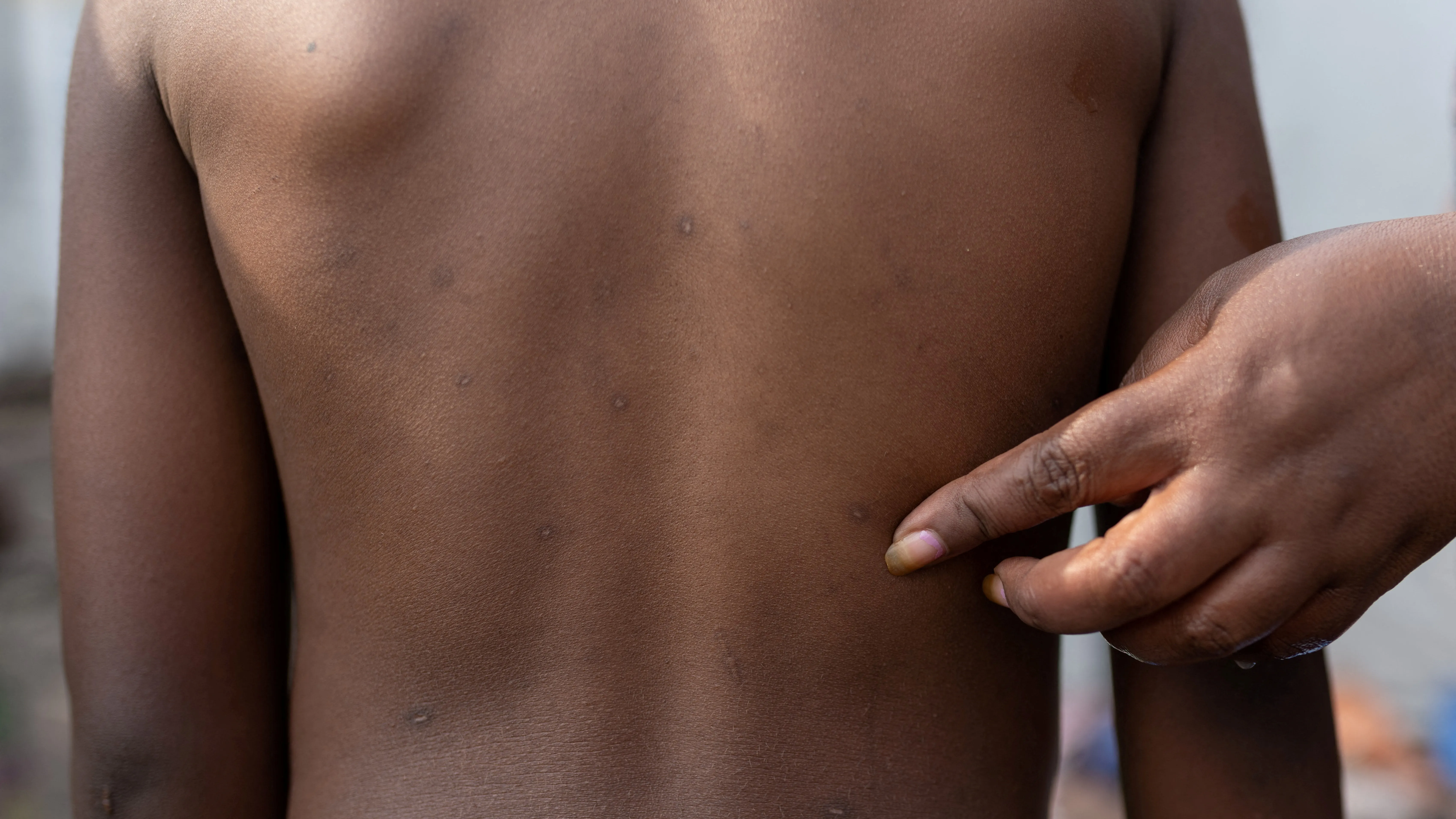 90' ČT24 - Rizika nové varianty mpox