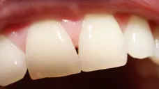 Zdravé zuby