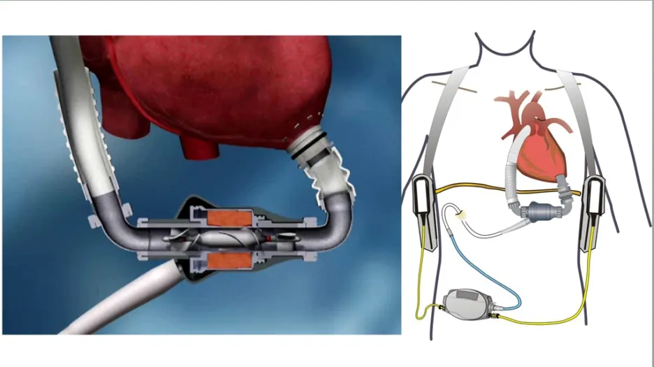 Implantabilní dlouhodobá srdeční podpora