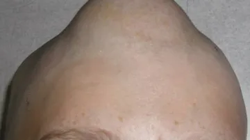 Brněnští lékaři zavedli do praxe metronomickou léčbu nádorů