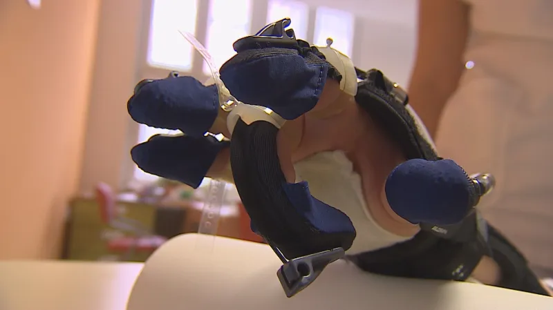 Robotická ruka pomůže lidem po úrazu i těm s vrozenou nemocí
