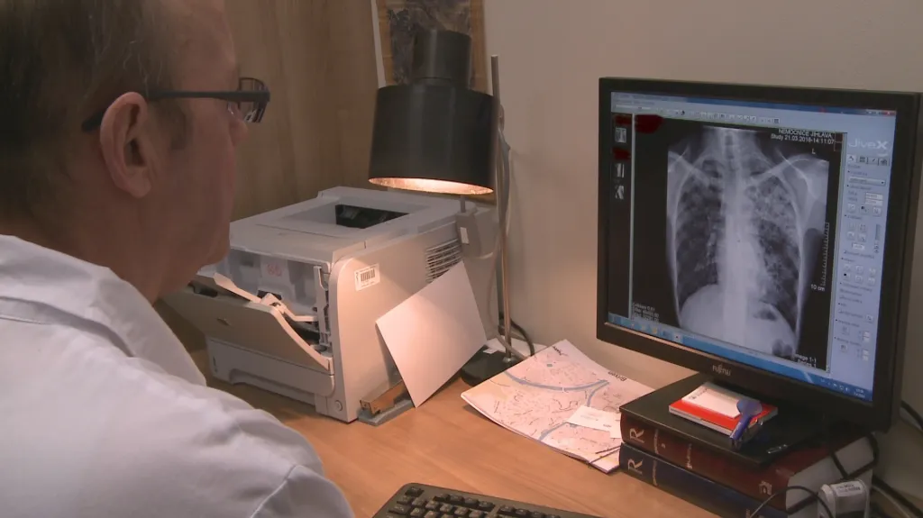 Tuberkulinové testy onemocnění neprokázaly, část dětí musí ještě na rentgen