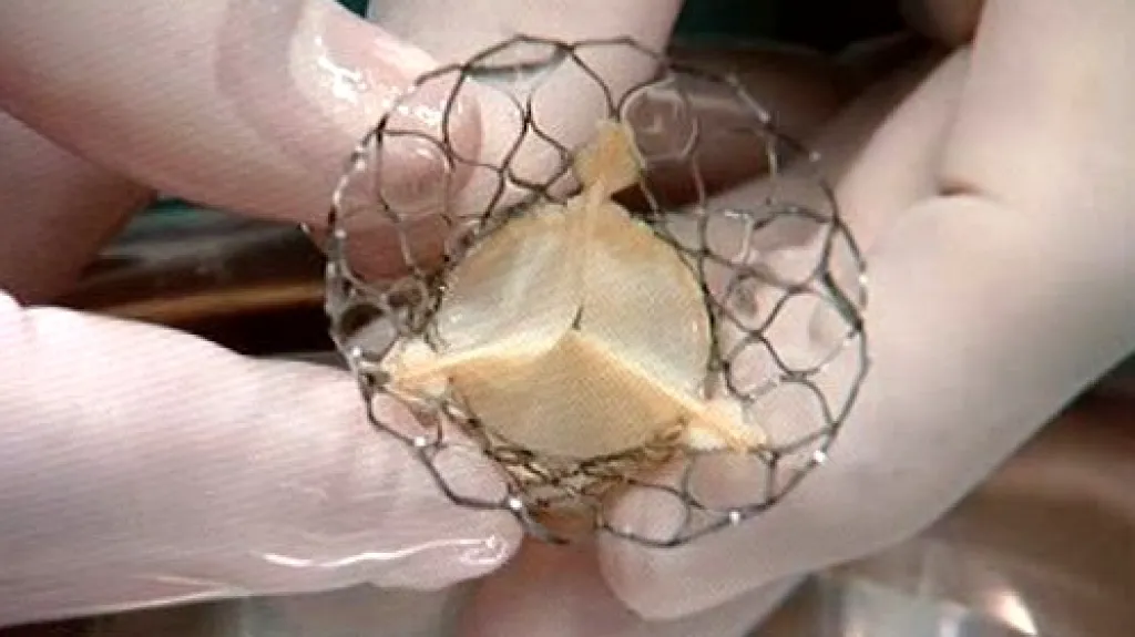 Umělá srdeční chlopeň