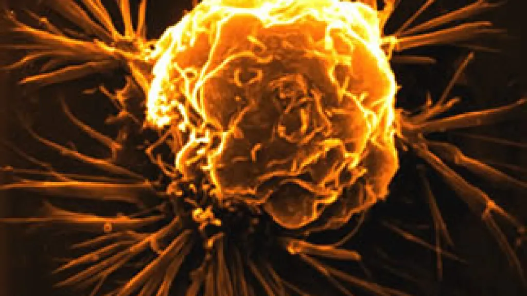 Rakovinná buňka prsu