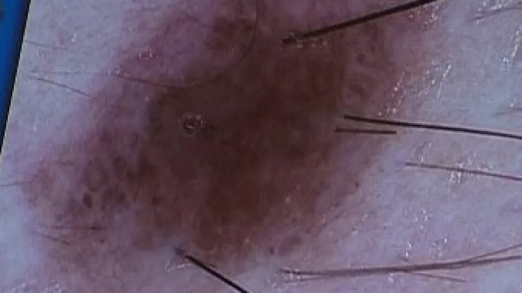 Pigmentové znaménko