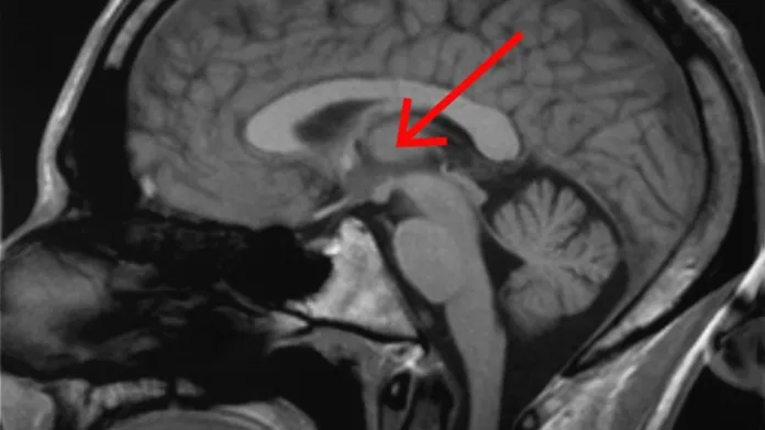 Thalamus je označený červenou šipkou