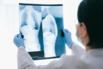 Odborníci doporučují rozšířit screening rakoviny plic