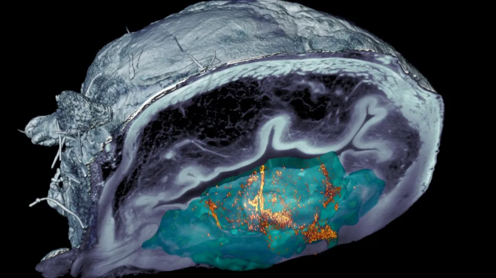 Rakovina močového měchýře