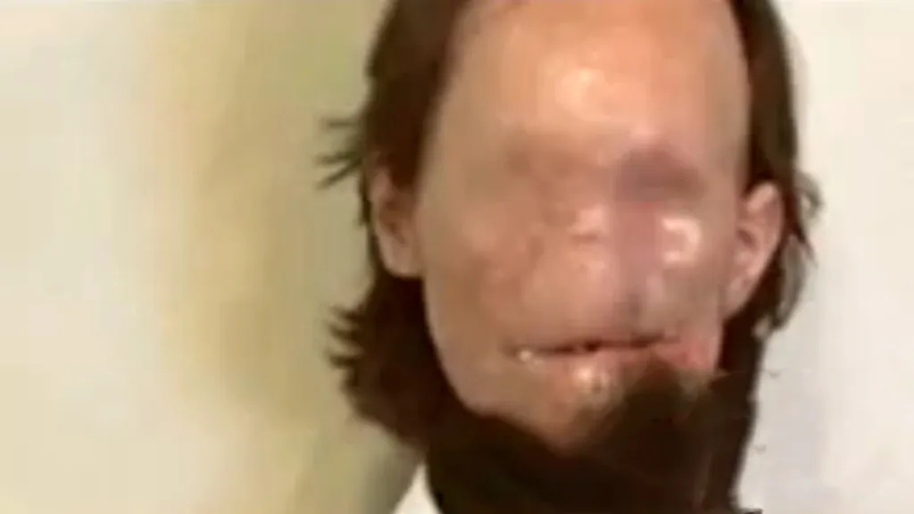 Dallas Wiens před transplantací obličeje