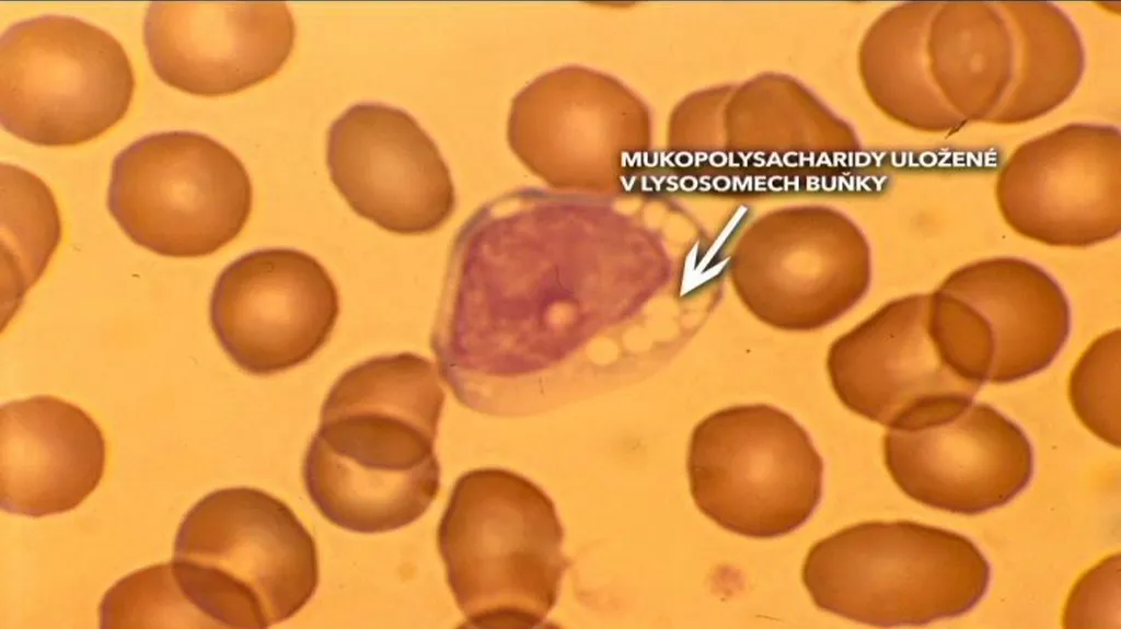 mukopolysacharidóza