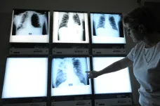 Případů tuberkulózy je v Česku víc než loni. Důvodem může být migrace i koronavirová pandemie